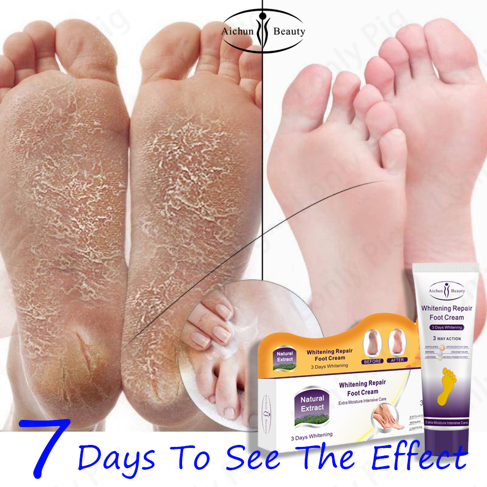 A Super Store Aichun crack heel remover cream, kalyo removal for foot