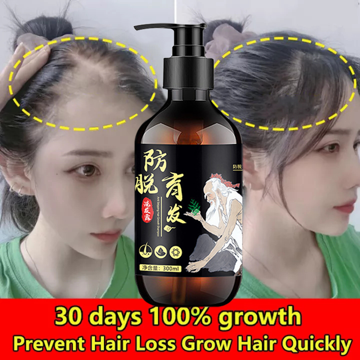 15/30/50ml Hair Growth Serum Anti Preventing Hair Loss Alopecia Liquid  Damaged Hair Repair Growing Faster(Spray Type) Shopee Malaysia | Ginger  King Anti Hair Loss Spray 50ml 