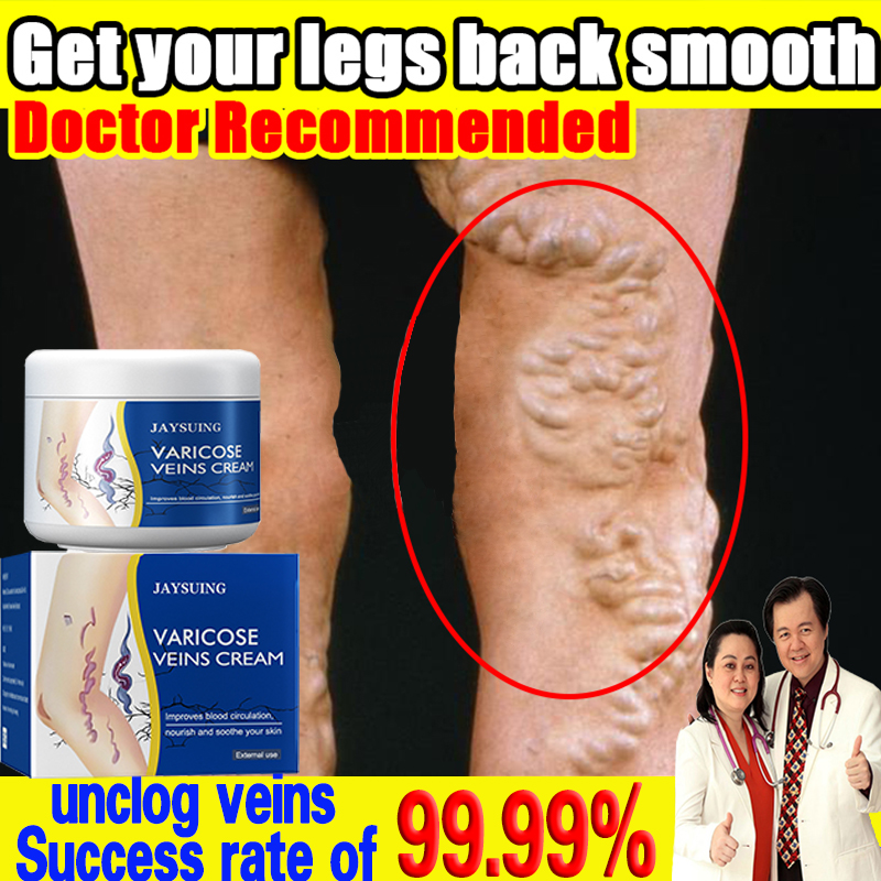 JAYSUING Varicose Vein Cream 50g Varicose Vein Ointment Relieve ...