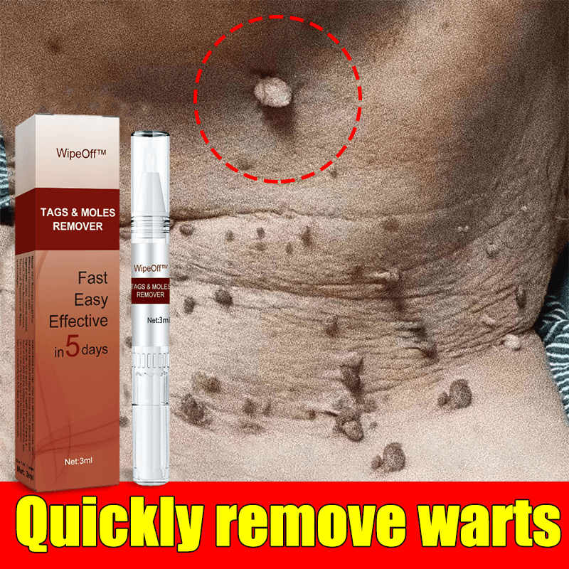 Warts Remover Original Watson Kasoy Oil Warts Remover Legit Warts