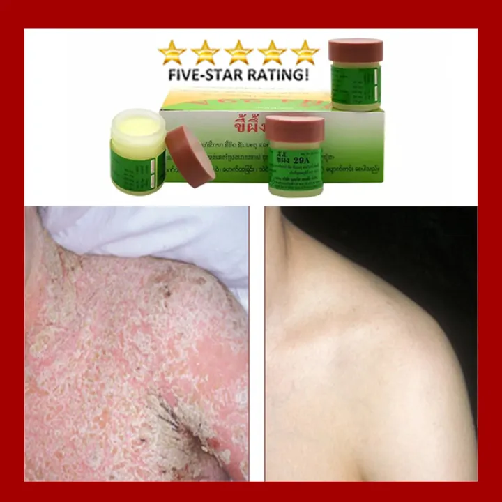 salicylic acid and eczema