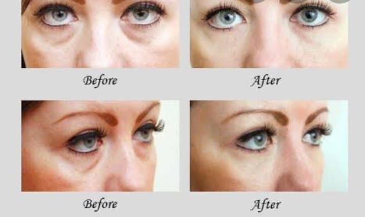 G G Skincare Eyebag Remover 10g Quick Safe Effective Cream 100 Authentic Eyebag Remover Original Lazada Ph