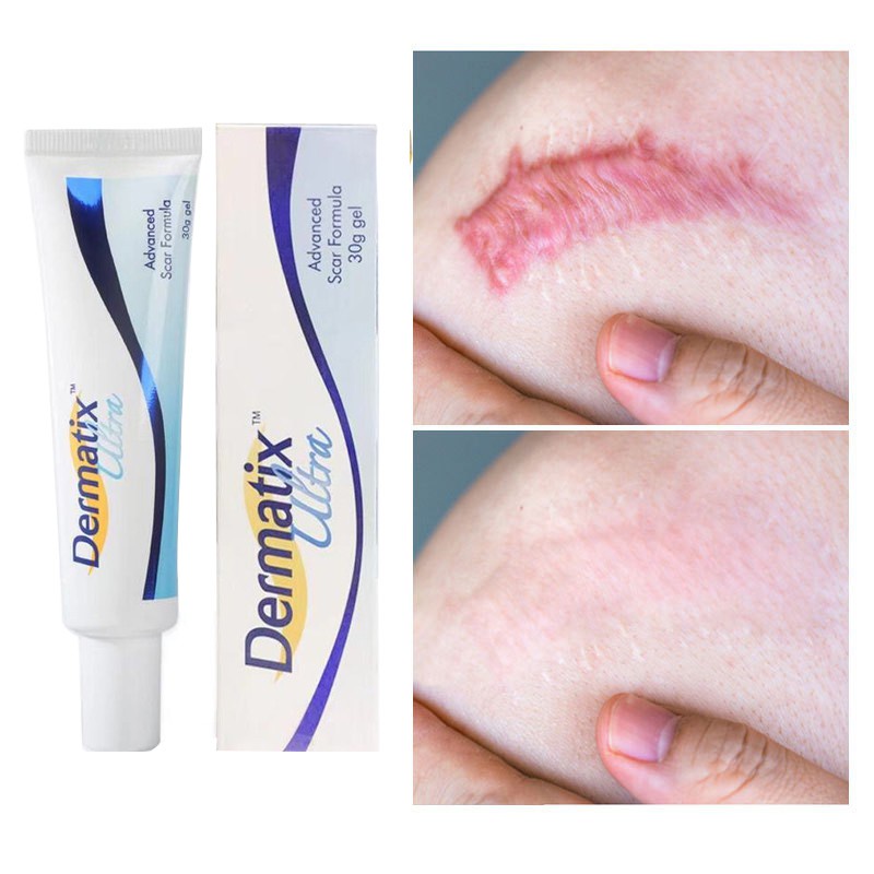 Australia Dermatix Scar Gel Acne Scar Remover Acne Scars Treatment Scar Removal Cream 15g