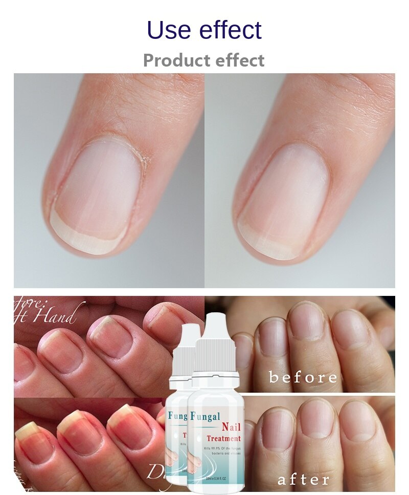 LANTHOME Nail Repair Essence Serum Nail Treatment Nail Care Fungal Nail