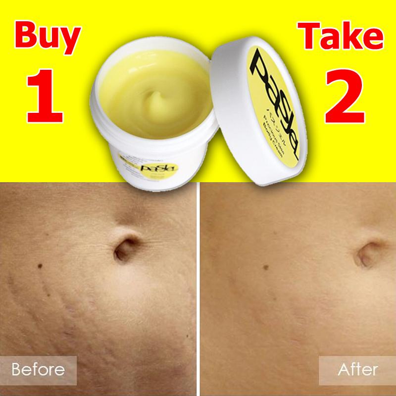 affordable stretch mark removal