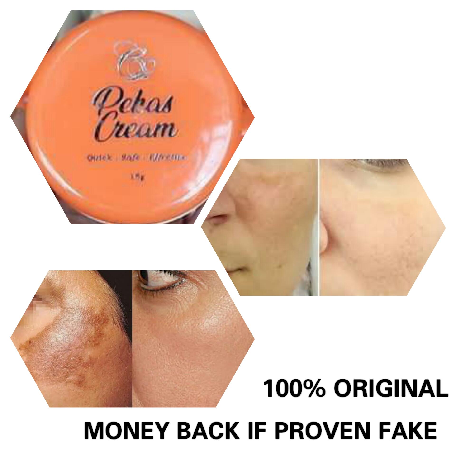 hyperpigmentation melasma treatment cream