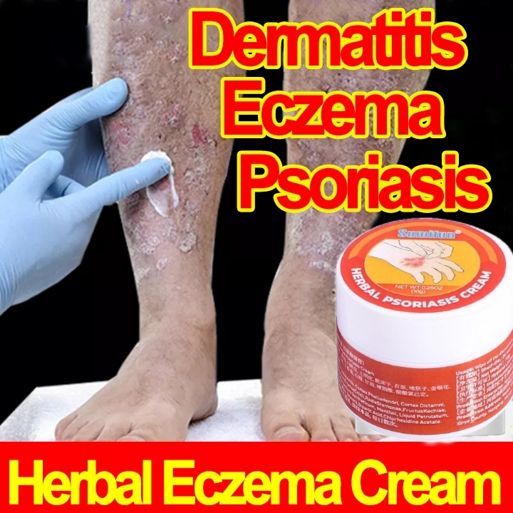 Psoriasis Eczema Ointment Treatment Cream Herbal Antibacterial Cream