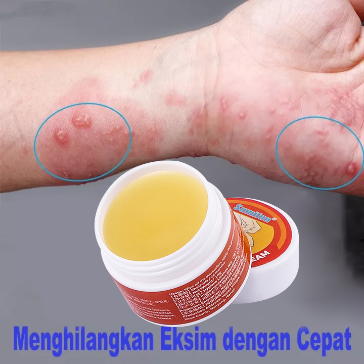 Psoriasis Eczema Cream Itchy cream Antibacterial Ointment vaginal itch