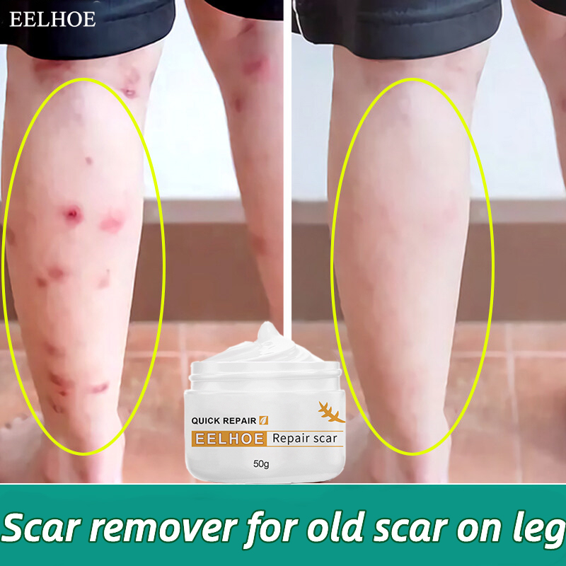 Authentic Eelhoe Scar Cream Tcm Scar Remover Gel Burn Scar Repair Cream For Old Scar On Leg 9397