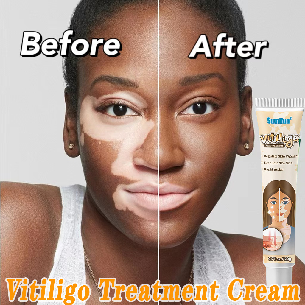 Vitiligo Removal Cream Eliminates White Patches in Vitiligo 20g Herbal