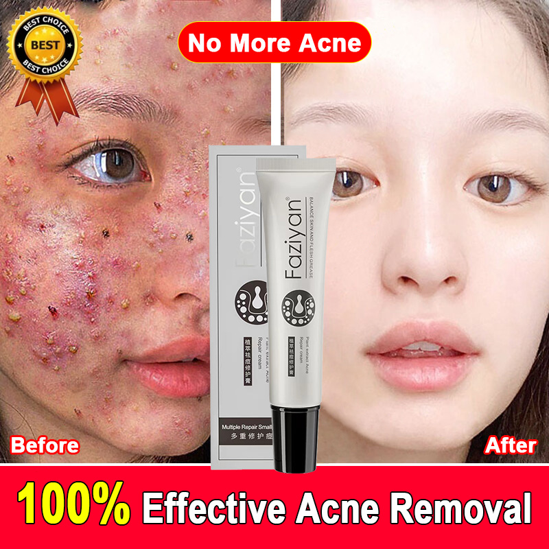 【FAZIYAN】Quickly Pimple Remover Cream Acne Repair Cream Fades Acne