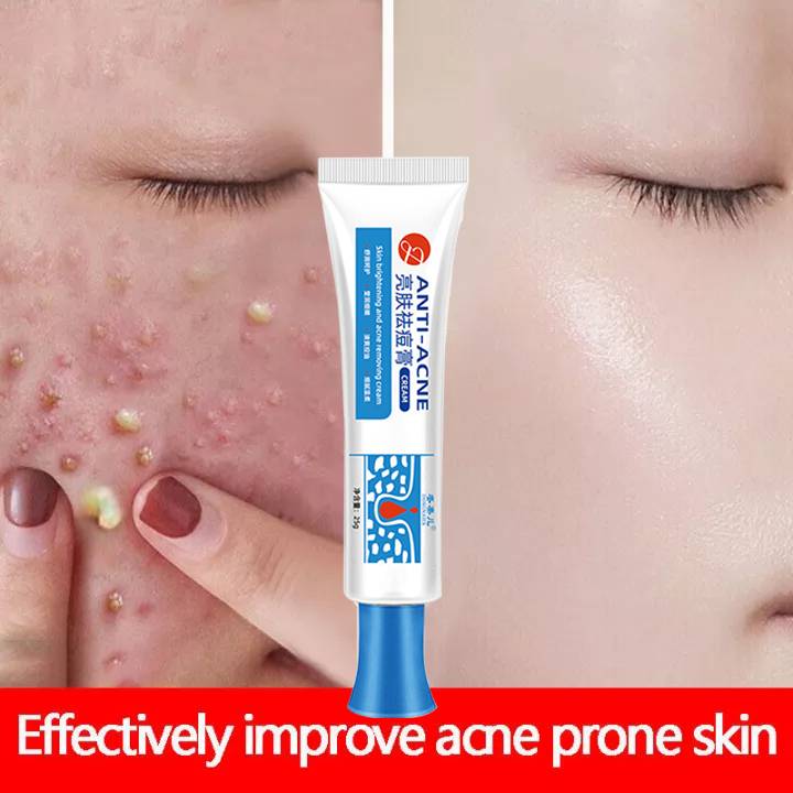 Remove Pimples Quickly Remover Acne Cream Fades Acne Marks Repairs Acne