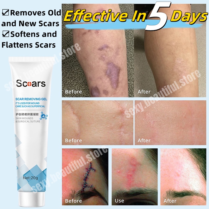 Scar remover for old scar on leg Effective Scar Repairing Gel light ...