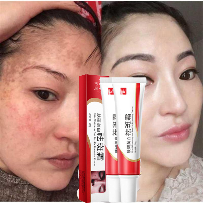 100% Effective and Original Whitening Freckle Cream Remover Original ...