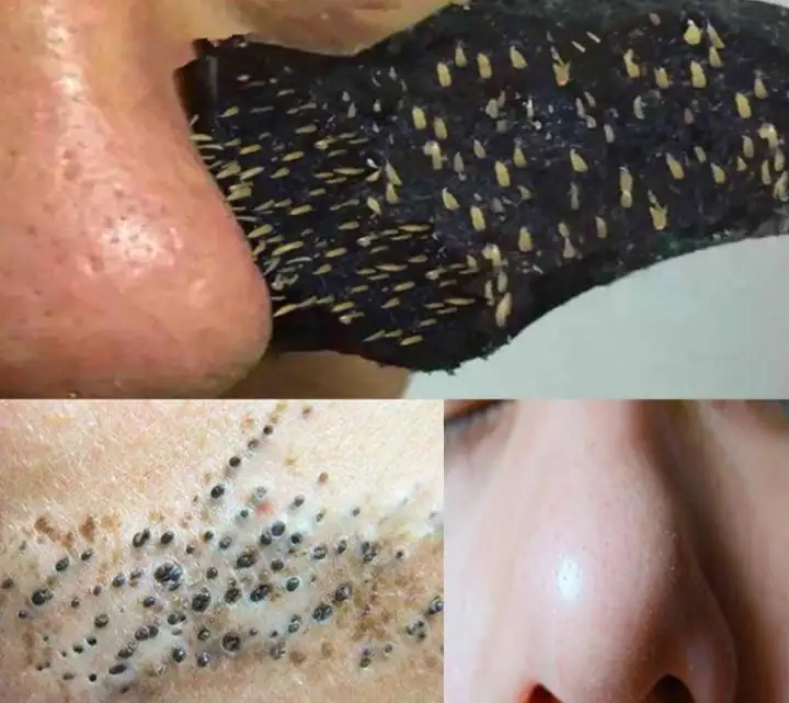 blackhead remover deep