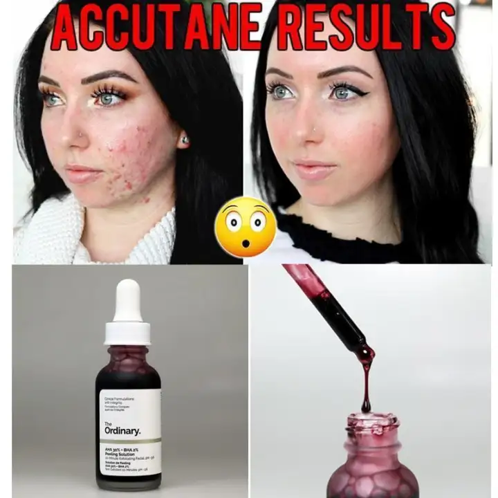 the ordinary acne marks
