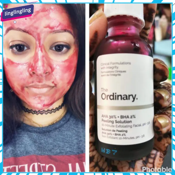 the ordinary peeling solution blackheads