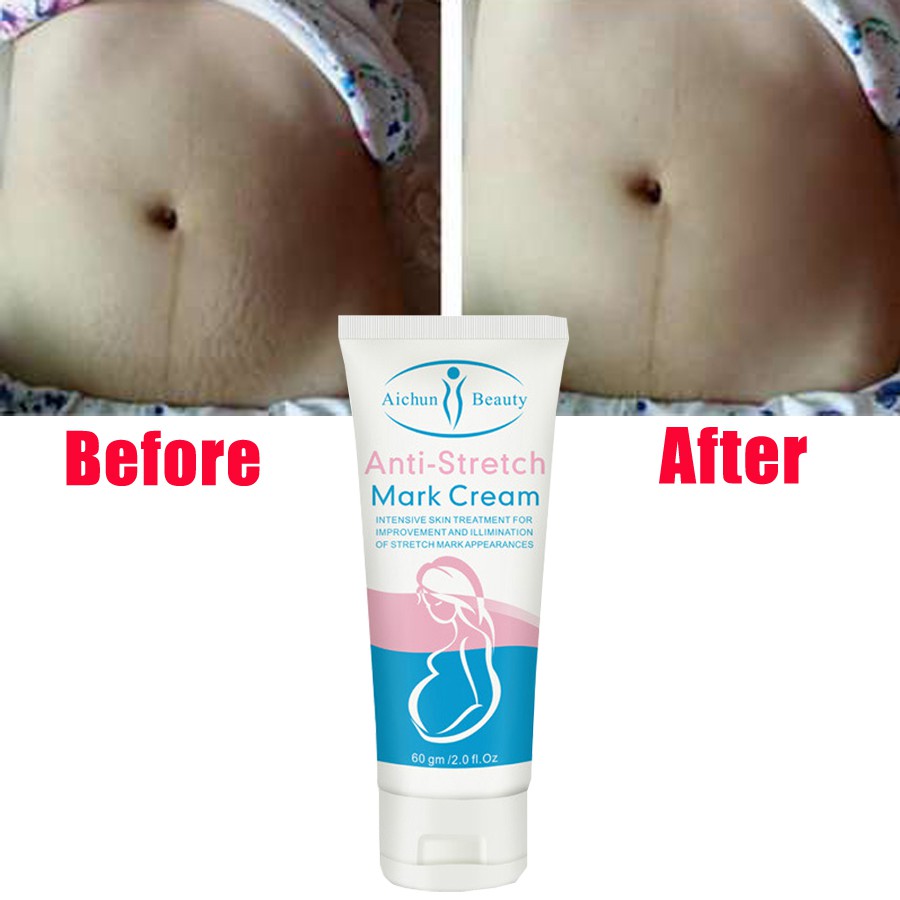 Snail Stretch Mark Cream For Pregnancy Repair Scar Slack Line Abdomen