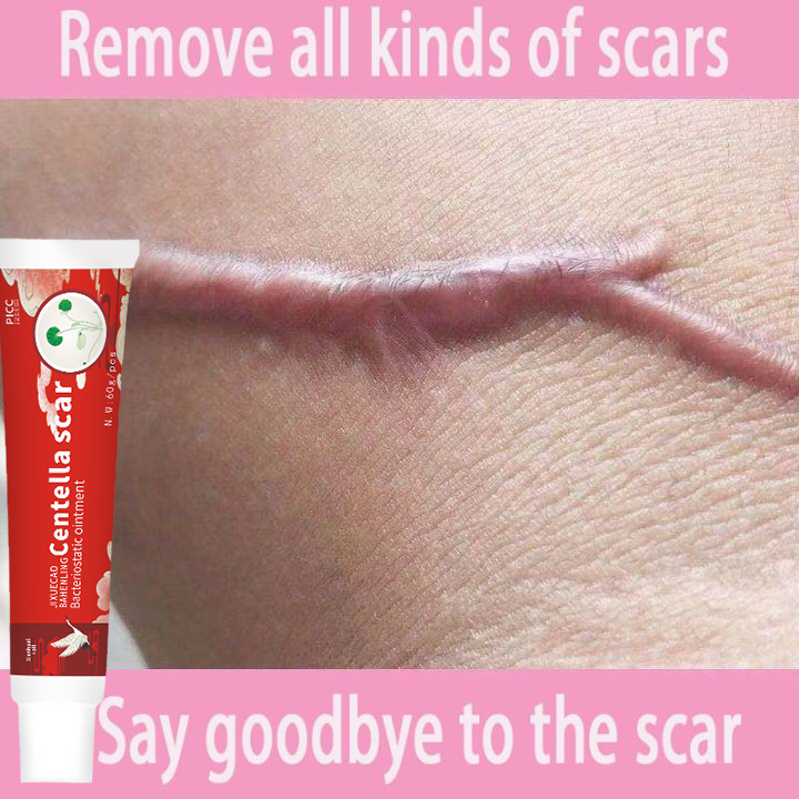 removal cream old scars repair facial bump scar mark acne spots acne