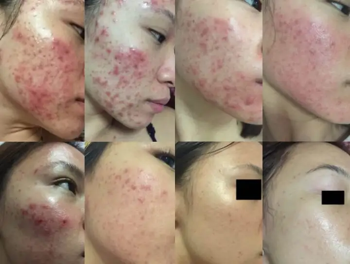 acne redness removal cream