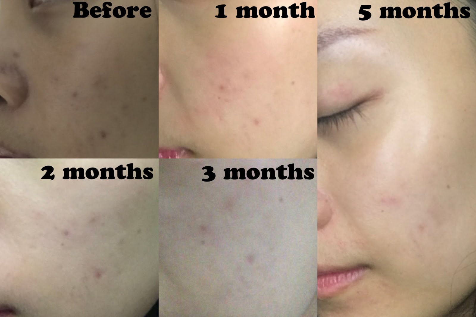 niacinamide the ordinary for acne