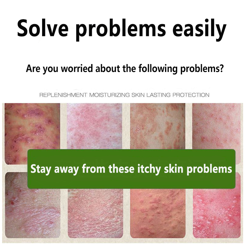 ♀ 【Quick itching relief】 dermatitis antipruritic cream 25g Psoriasis Eczema Treatment Cream
