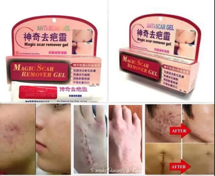acne spot treatment shoppers