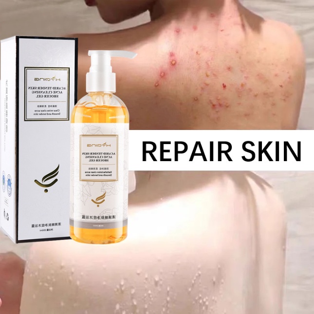 【BUY 2 GET 1 FREE】Anti Acne Shower Gel Mite Removal Bath Lotion Amino Acid Antibacterial Deep
