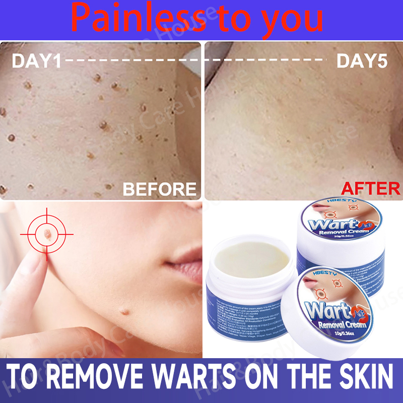 【painless To You】warts Remover Original Cream Effectively Remove Common Warts Flat Warts