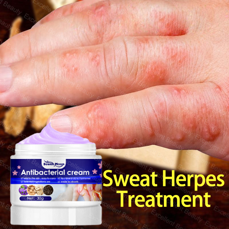 【Quick Itch Relief】Sweat Herpes Treatment 30g Blisters Ointment Gamot