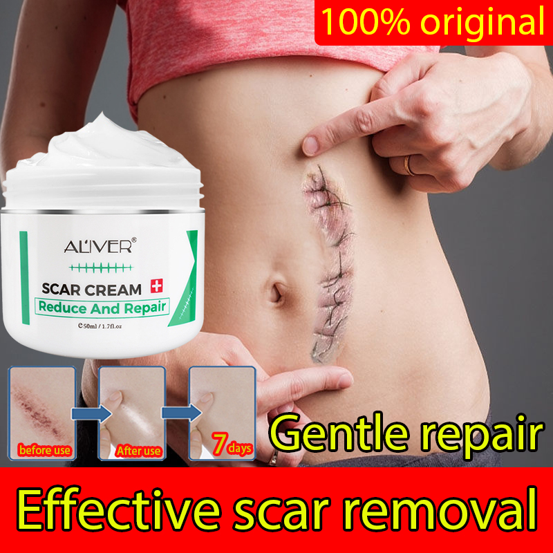 Aliver Scar Remover For Old Scar On Leg Stretch Mark Remover Acne Scar Remover Peklat Remover 8630