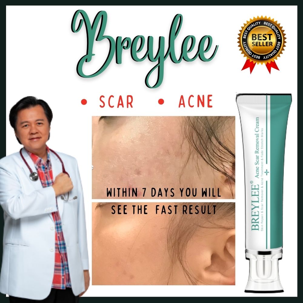 original-breylee-acne-scar-removal-cream-lazada-ph