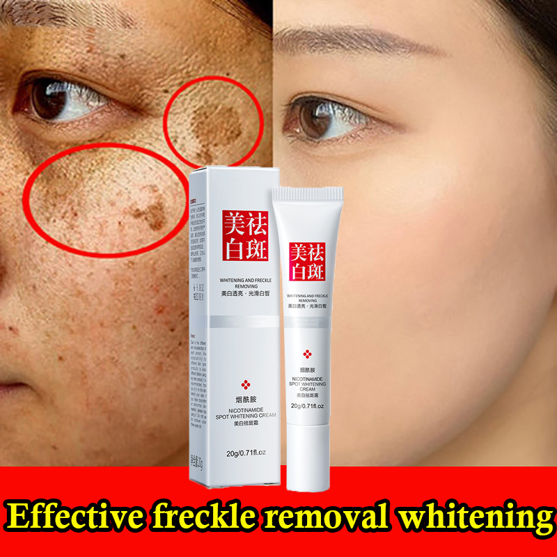 Whitening cream Fast Effective freckle removal whitening cream melasma