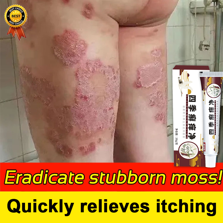 100Eradicative Psoriasis Ointment Psoriasis Eczema Cream Psoriasis