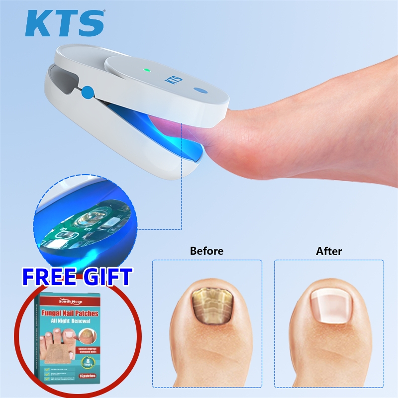 KTS Onychomycosis treatment Ingrown toenail onychomycosis nail fungus