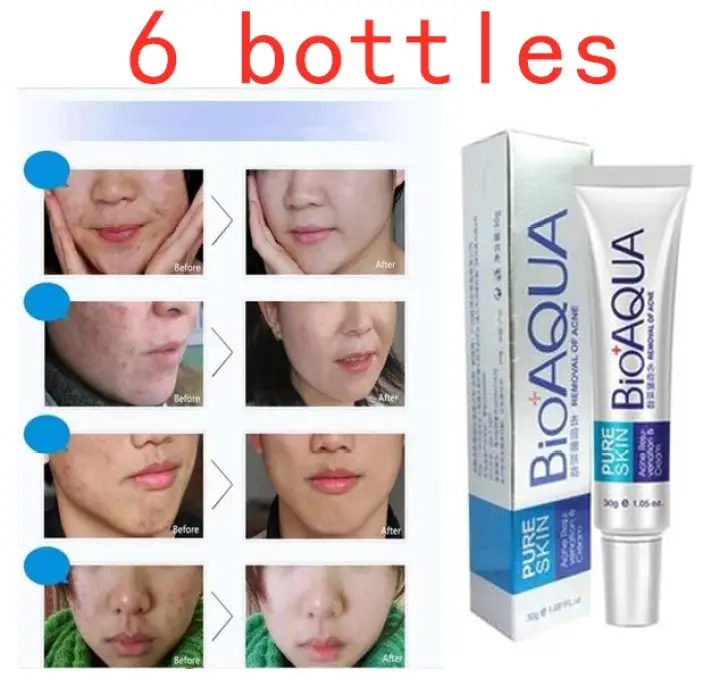 bioaqua anti acne cream