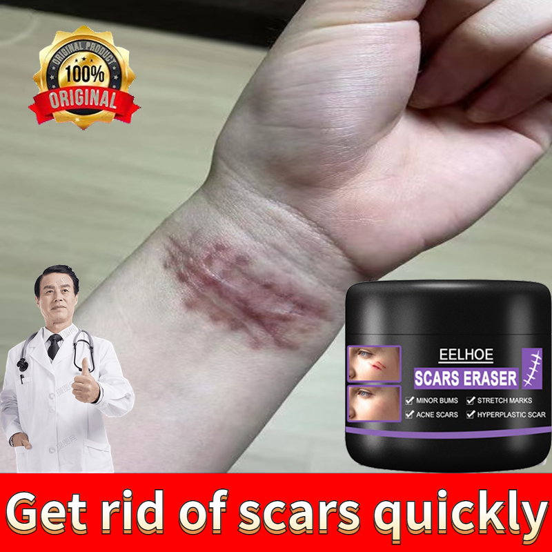 EELHOE scars removal cream acne scar remover for old scar on face cream for  old scars remover For Face & New Scars From Cuts,Stretch Marks & Scar  Removal Cream Skin Repair Cream