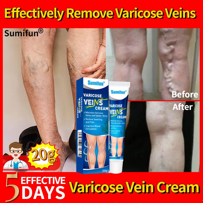 【Doctor Varicose Veins Remover Effective Cream 20g