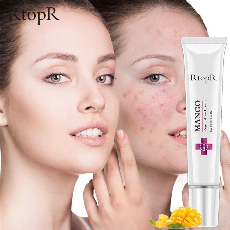 mango repair acne cream