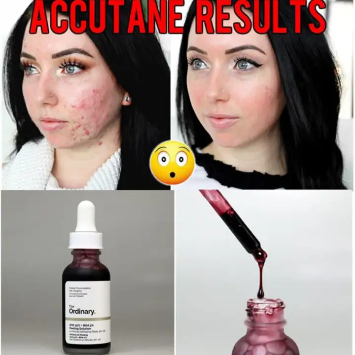 the ordinary serum scars
