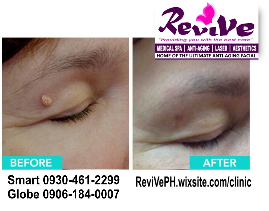 Skin tag Removal (Laser Treatment) Service at ReviVe Skin & Aesthetics  Binakayan, Kawit Cavite | Lazada PH