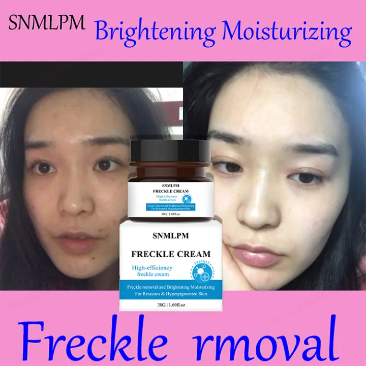 snmlpm freckle cream