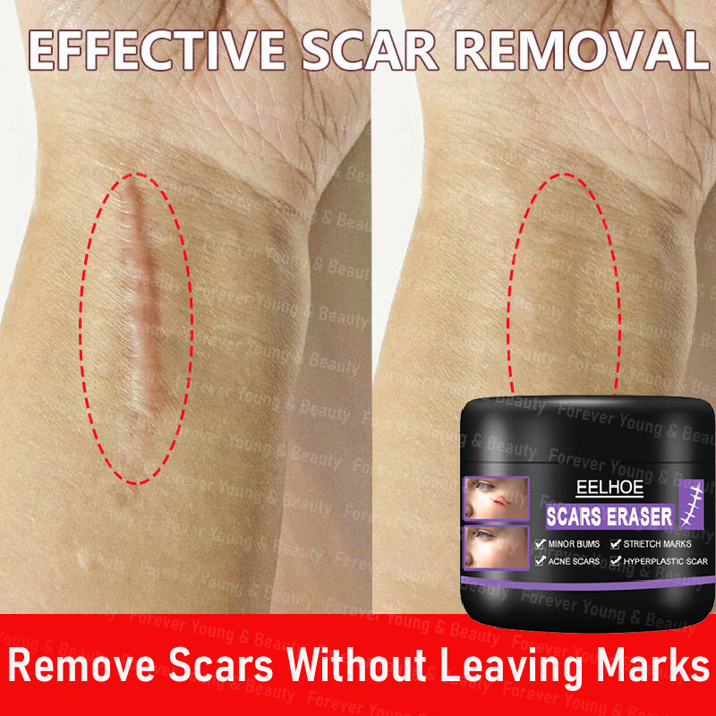 Scar Remover for old scar on leg stretch mark remover acne scar remover