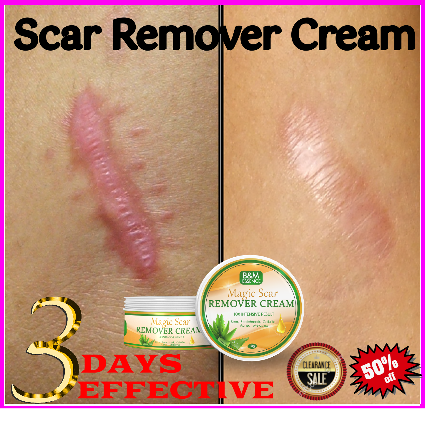 BEST SELLER EFFECTIVE B&M Essence Scar Remover Cream Remove Scar scar