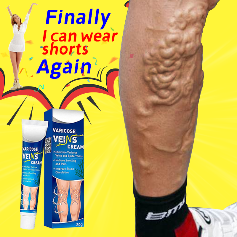 Finally I can wear shorts/skirts again ☜ ☞ Ugly veins disappear ☜ anti