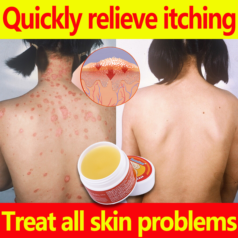 【Immediate results】Eczema ointment Psoriasis Treatment Cream 20g For