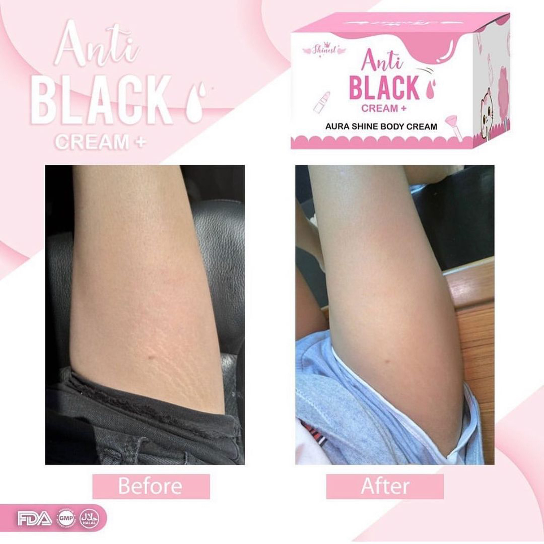 Under Butt Whitening After 1 Session Only. 😱 Whiten that Under Butt  without spending that much with Marikit Pico Laser Whitening. ✨