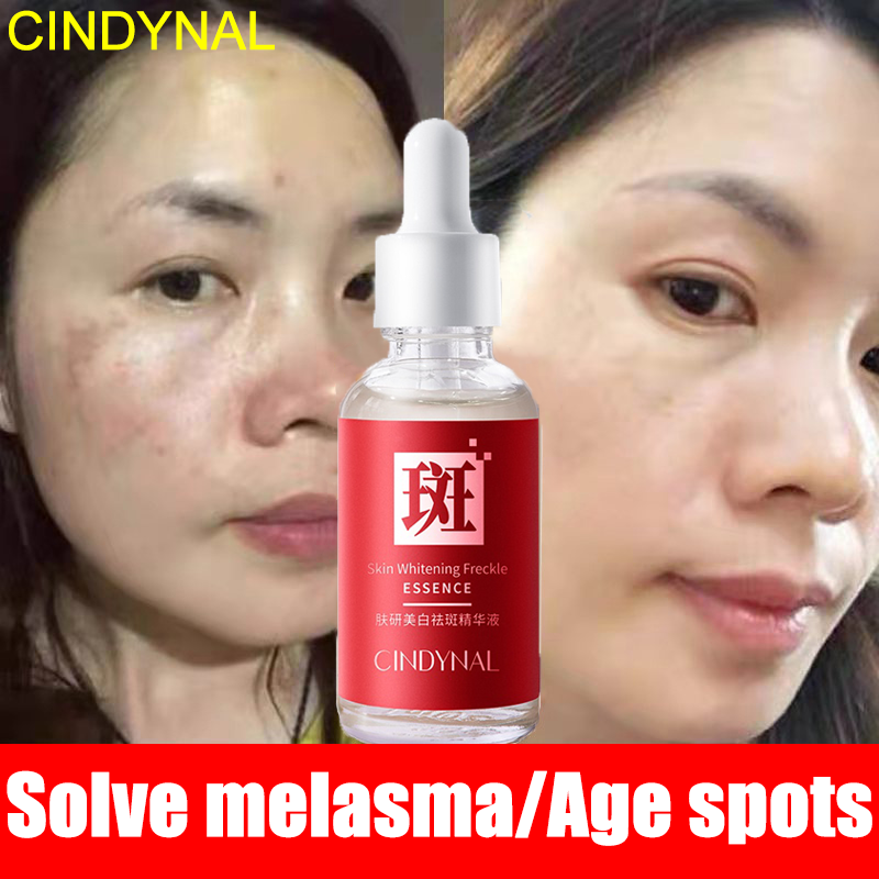 【Global select】Melasma Serum Age Spot Removal Whitening Serum dark spot