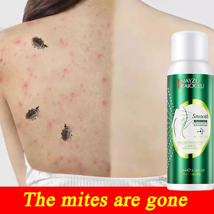 Acne Remover Spray Mite Remove Spray Oil Control Chest Back Acne