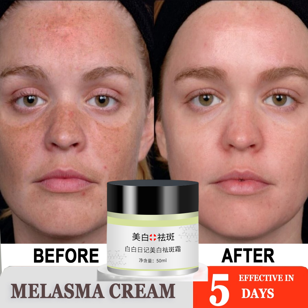 Whitening Freckle Cream Remove Melasma Cream Remove Dark Spots Melanin